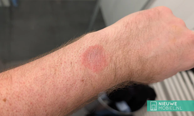 Contactdermatitis van een smartwatch Rode huidirritatie op de pols na het dragen van een smartwatch (contactdermatitis)